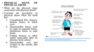 • PHYSICAL SIGNS OF
PHYSICALABUSE
• What are the physical signs
associated with physical abuse?
• Consider the possibility of
physical abuse when the child
has:
1. Unexplained bits, bruises,
broken bones, or black
eyes.
2. Questionable burns such
as cigar or cigarette burns,
immersion burns or rope
burns
3. Fading bruises or other
marks noticeable after an
absence from school.
4. Questionable cuts and
scrapes in the mouth, lips
or eyes.
https://th.bing.com/th/id/R.45b1ded3dc91ddf8172e8c852b955a63?rik=Ohu1zrBqzQS%2bjA&riu=http%3a%2f%2f
cacmercer.org%2fwp-content%2fuploads%2f2015%2f09%2fChild-
Abuse.jpg&ehk=4cBuhM%2fXqtd%2bDV%2b92VKSbftezec5II9y4iEiYe3sFZQ%3d&risl=&pid=ImgRaw&r=0
 