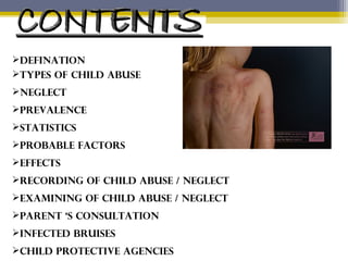 DEFINATION
TYPES OF CHILD ABUSE
NEGLECT
PREVALENCE
STATISTICS
PROBABLE FACTORS
EFFECTS
RECORDING OF CHILD ABUSE / NEGLECT
EXAMINING OF CHILD ABUSE / NEGLECT
PARENT ‘S CONSULTATION
INFECTED BRUISES
CHILD PROTECTIVE AGENCIES
 