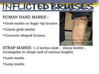 HUMAN HAND MARKS :HUMAN HAND MARKS :
Grab marks or finger tip bruisesGrab marks or finger tip bruises
Linear grab marksLinear grab marks
Crescent shaped bruisesCrescent shaped bruises
STRAP MARKS:STRAP MARKS: 1-2 inches wide , sharp border ,1-2 inches wide , sharp border ,
rectangular in shape and of various lengthsrectangular in shape and of various lengths
Lash marksLash marks
Loop marksLoop marks
 