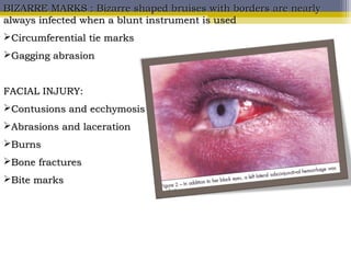 BIZARRE MARKS : Bizarre shaped bruises with borders are nearlyBIZARRE MARKS : Bizarre shaped bruises with borders are nearly
always infected when a blunt instrument is usedalways infected when a blunt instrument is used
Circumferential tie marksCircumferential tie marks
Gagging abrasionGagging abrasion
FACIAL INJURY:FACIAL INJURY:
Contusions and ecchymosisContusions and ecchymosis
Abrasions and lacerationAbrasions and laceration
BurnsBurns
Bone fracturesBone fractures
Bite marksBite marks
 