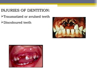 INJURIES OF DENTITION:INJURIES OF DENTITION:
Traumatized or avulsed teethTraumatized or avulsed teeth
Discoloured teethDiscoloured teeth
 