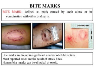 BITE MARKS
BITE MARK: defined as mark caused by teeth alone or in
combination with other oral parts.
Bite marks are found in significant number of child victims.
Most reported cases are the result of attack bites.
Human bite marks can be elliptical or ovoid.
 