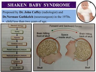 SHAKEN BABY SYNDROME
Proposed by Dr. John Caffey (radiologist) and
Dr.Nerman Guthkelch (neurosurgeon) in the 1970s.
• child less than two years of age.
 