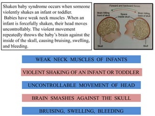 Shaken baby syndrome occurs when someone
violently shakes an infant or toddler.
Babies have weak neck muscles .When an
infant is forcefully shaken, their head moves
uncontrollably. The violent movement
repeatedly throws the baby’s brain against the
inside of the skull, causing bruising, swelling,
and bleeding.
VIOLENT SHAKING OF AN INFANT OR TODDLER
WEAK NECK MUSCLES OF INFANTS
UNCONTROLLABLE MOVEMENT OF HEAD
BRAIN SMASHES AGAINST THE SKULL
BRUISING, SWELLING, BLEEDING
 