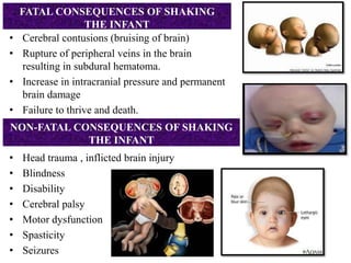 FATAL CONSEQUENCES OF SHAKING
THE INFANT
• Cerebral contusions (bruising of brain)
• Rupture of peripheral veins in the brain
resulting in subdural hematoma.
• Increase in intracranial pressure and permanent
brain damage
• Failure to thrive and death.
NON-FATAL CONSEQUENCES OF SHAKING
THE INFANT
• Head trauma , inflicted brain injury
• Blindness
• Disability
• Cerebral palsy
• Motor dysfunction
• Spasticity
• Seizures
 
