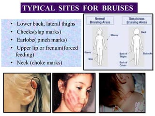• Lower back, lateral thighs
• Cheeks(slap marks)
• Earlobe( pinch marks)
• Upper lip or frenum(forced
feeding)
• Neck (choke marks)
TYPICAL SITES FOR BRUISES
 