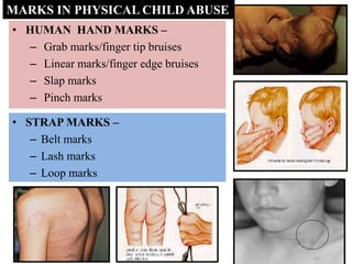 • HUMAN HAND MARKS –
– Grab marks/finger tip bruises
– Linear marks/finger edge bruises
– Slap marks
– Pinch marks
MARKS IN PHYSICAL CHILD ABUSE
• STRAP MARKS –
– Belt marks
– Lash marks
– Loop marks
 