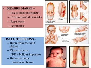 • BIZARRE MARKS –
– Use of blunt instrument
– Circumferential tie marks
– Rope burns
– Gag marks
• INFLICTED BURNS –
– Burns from hot solid
objects
– Cigarette burns
(DD – bullous impetigo)
– Hot water burns
Immersion burns
 
