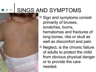SINGS AND SYMPTOMS
 Sign and symptoms consist
primarily of bruises,
scratches, burns,
hematomas and fractures of
long bones, ribs or skull as
well as discomfort and pain.
 Neglect, is the chronic failure
of adults to protect the child
from obvious physical danger
or to provide the care
needed.
 
