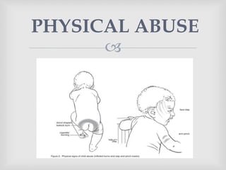 
PHYSICAL ABUSE
 
