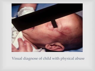
Visual diagnose of child with physical abuse
 