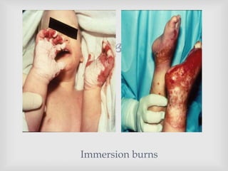 
Immersion burns
 