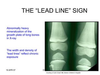 19 APR 07 Dr. M. S. Prasad 58
THE “LEAD LINE” SIGN
Abnormally heavy
mineralization of the
growth plate of long bones
in X-ray
The width and density of
“lead lines” reflect chronic
exposure
Courtesy of John Graef, MD, Boston Children's Hospital
 
