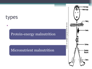 types
•
Protein-energy malnutrition
Micronutrient malnutrition
 