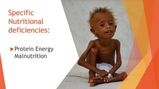 Specific
Nutritional
deficiencies:
Protein Energy
Malnutrition
 