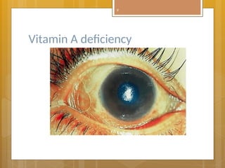 Eye Deficiency Childhood blindness disease of the eye .pptx