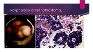 Morphology of retinoblastoma.
 