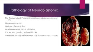 Pathology of Neuroblastoma.
Site :Paravertebral, Posterior mediastinum, abdomen ,Adrenal
1/3
Gross appearance:
Nodular, of varying size
May be encapsulated or infiltrative
Cut section: grey-tan, soft and friable
Varigated, necrosis, hemorrhage, calcification, cystic change
 