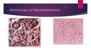 Microscopy of Neuroblastoma.
 