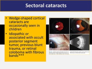 Sectoral cataracts
• Wedge-shaped cortical
cataracts are
occasionally seen in
children
• Idiopathic or
associated with occult
posterior segment
tumor, previous blunt
trauma, or retinal
coloboma with fibrous
bands***
 