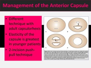 Management of the Anterior Capsule
• Different
technique with
adult capsulorhexis
• Elasticity of the
capsule is greatest
in younger patients
• 2-incision push-
pull technique
 