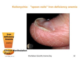 Iron deficiency Anemia (cont.) Clinical Manifestation (Cont.)   Koilonychia:  "spoon nails”  Iron deficiency anemia 
