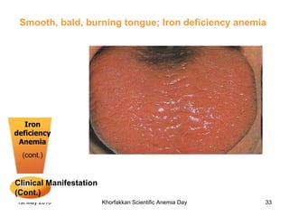 Iron deficiency Anemia (cont.) Clinical Manifestation (Cont.)   Smooth, bald, burning tongue; Iron deficiency anemia  