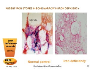 Iron deficiency Anemia (cont.) Bone marrow  ABSENT IRON STORES IN BONE MARROW IN IRON DEFICIENCY Normal control Iron deficiency 