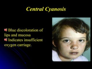 Central Cyanosis
Blue discoloration of
lips and mucosa
Indicates insufficient
oxygen carriage.
 