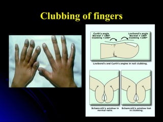 Clubbing of fingers
 