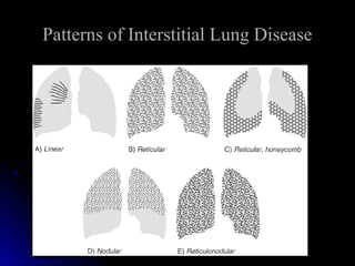 Patterns of Interstitial Lung DiseasePatterns of Interstitial Lung Disease
 