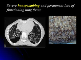 Severe honeycombing and permanent loss of
functioning lung tissue
 