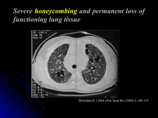 Severe honeycombing and permanent loss of
functioning lung tissue
Dinwiddie R. ( 2004 ) Ped. Resp Rev (2004) 5, 108–115Dinwiddie R. ( 2004 ) Ped. Resp Rev (2004) 5, 108–115
 