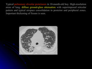 Typical pulmonary alveolar proteinosis in 10-month-old boy. High-resolution
areas of lung. diffuse ground-glass attenuation with superimposed reticular
pattern and typical airspace consolidation in posterior and peripheral zones.
Important thickening of fissure is seen.
 