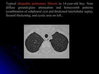 Typical idiopathic pulmonary fibrosis in 14-year-old boy. Note
diffuse ground-glass attenuation and honeycomb patterns
(combination of subpleural cyst and thickened interlobular septa),
fissural thickening, and cystic area on left...
 