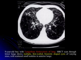 9-year-old boy with Langerhans histiocytosis of lung. HRCT scan through
lower lungs shows multiple, thin-walled, bizarrely shaped cysts of varying
sizes, with scattered small nodules in anterior lungs.
 