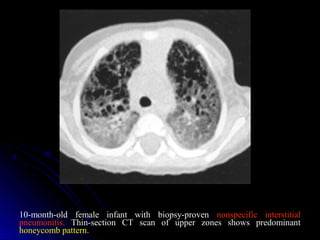 10-month-old female infant with biopsy-proven nonspecific interstitial
pneumonitis. Thin-section CT scan of upper zones shows predominant
honeycomb pattern.
 