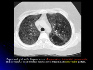 13-year-old girl with biopsy-proven desquamative interstitial pneumonitis.
Thin-section CT scan of upper zones shows predominant honeycomb pattern.
 