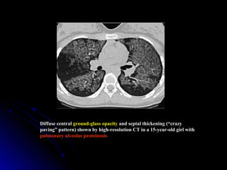 Diffuse central ground-glass opacity and septal thickening (“crazy
paving” pattern) shown by high-resolution CT in a 15-year-old girl with
pulmonary alveolar proteinosis
 