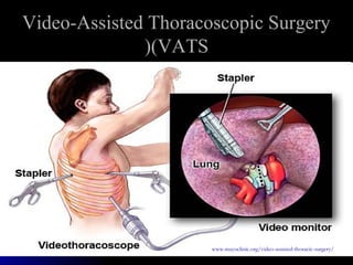 Video-Assisted Thoracoscopic SurgeryVideo-Assisted Thoracoscopic Surgery
(VATS(VATS((
www.mayoclinic.org/video-assisted-thoracic-surgery/
 