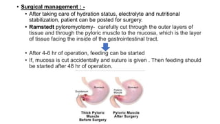 • Surgical management : -
• After taking care of hydration status, electrolyte and nutritional
stabilization, patient can be posted for surgery.
• Ramstedt pyloromyotomy- carefully cut through the outer layers of
tissue and through the pyloric muscle to the mucosa, which is the layer
of tissue facing the inside of the gastrointestinal tract.
• After 4-6 hr of operation, feeding can be started
• If, mucosa is cut accidentally and suture is given . Then feeding should
be started after 48 hr of operation.
 
