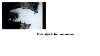 Claw sign in barium enema
 