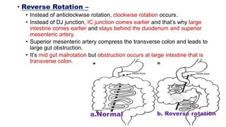 • Reverse Rotation –
• Instead of anticlockwise rotation, clockwise rotation occurs.
• Instead of DJ junction, IC junction comes earlier and that’s why large
intestine comes earlier and stays behind the duodenum and superior
mesenteric artery.
• Superior mesenteric artery compress the transverse colon and leads to
large gut obstruction.
• It’s mid gut malrotation but obstruction occurs at large intestine that is
transverse colon.
a.Normal b. Reverse rotation
 