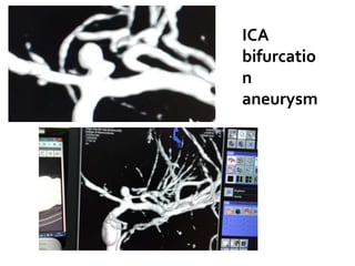 Childhood intracranial aneurysms | PPTX