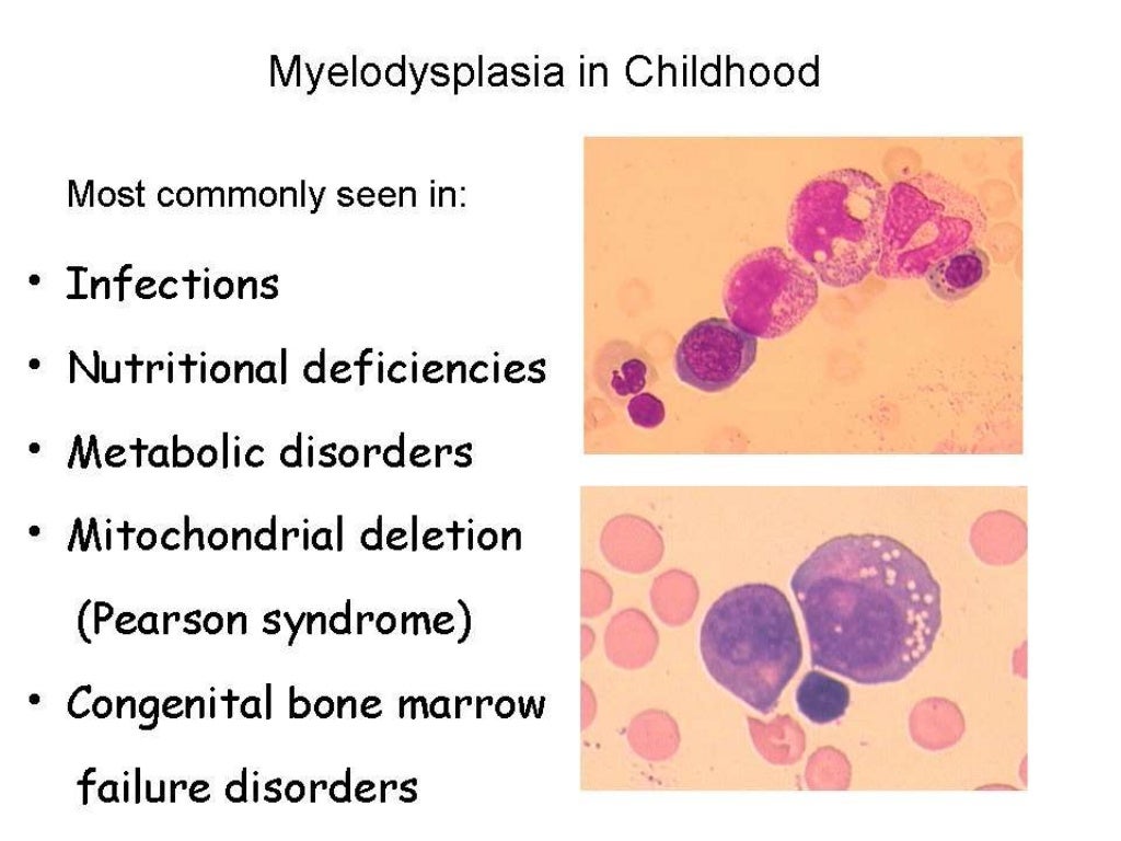 Childhood mds unlocking the old mystery