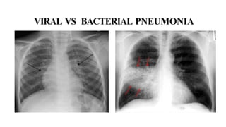 VIRAL VS BACTERIAL PNEUMONIA
 