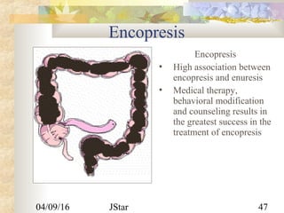 04/09/16 JStar 47
Encopresis
Encopresis
 High association between
encopresis and enuresis
 Medical therapy,
behavioral modification
and counseling results in
the greatest success in the
treatment of encopresis
 