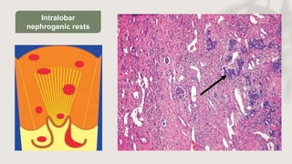 CHILDHOOD RENAL TUMORS.pptx Pediatric renal pathology | PPTX