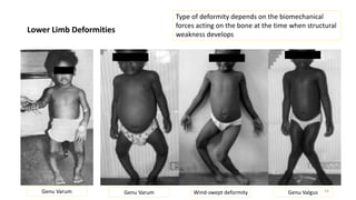 Land Rickets An Overview of Childhood Rickets | PPTX