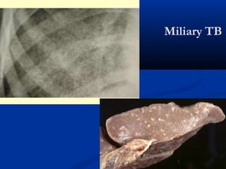 Miliary TB
 